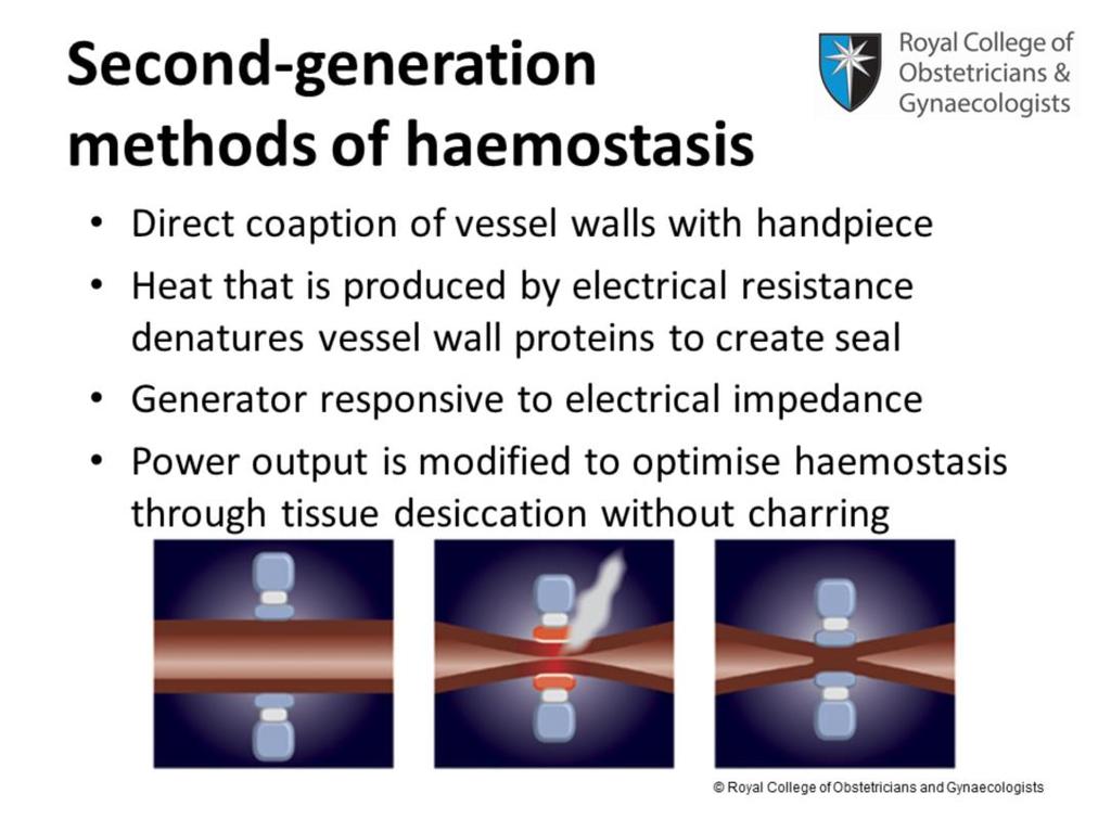 In second-generation methods of haemostasis, special instruments have been developed which bring the vessel walls together with a hand piece.