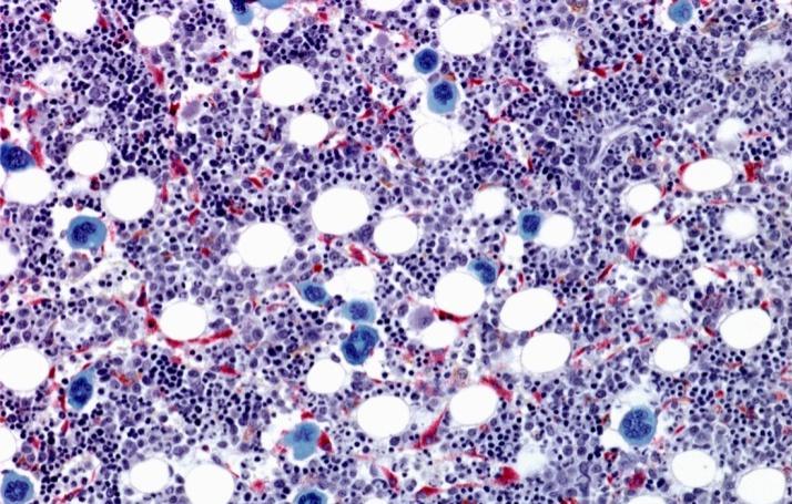 Multiple myeloma cells grow and crowd out the healthy