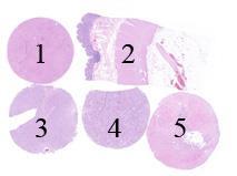 Assessment Run 53 208 E-Cadherin (ECAD) Material The slide to be stained for ECAD comprised:. Liver, 2. Colon, 3-4. Ductal breast carcinomas, 5. Lobular breast carcinoma.