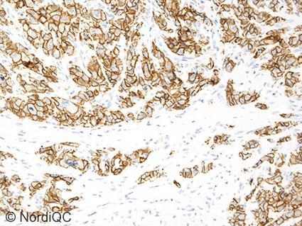 Fig. a (x200) Optimal ECAD staining of the ductal breast carcinoma (tissue core no.