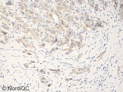 Virtually all neoplastic cells show a strong and distinct membranous staining reaction. Same protocol used in Figs