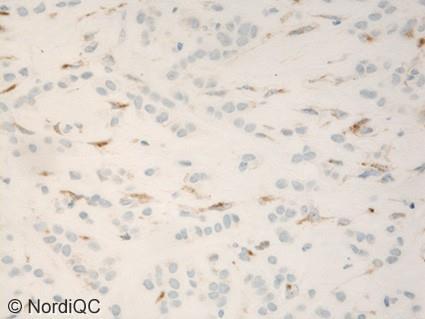 Fig. 5a. (x400) Insufficient ECAD staining of the lobular breast carcinoma applying the same protocol as in Fig. 4b.