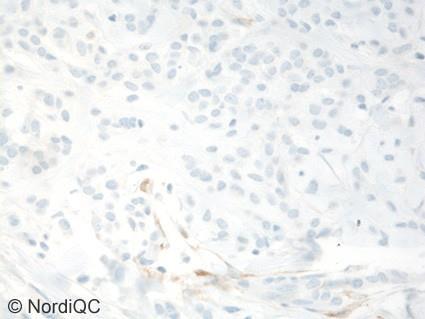 Although weaker in most cases, assays based on this primary Ab typically gave this aberrant staining pattern despite laboratories applying several different protocol settings (e.g. low sensitive detection systems and/or shorter incubation time in primary Ab).