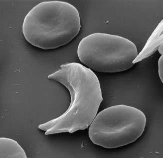 (iii) Give one other way a red blood cell is adapted to its function. [1] The photograph shows the red blood cells of a patient with a genetic disease.