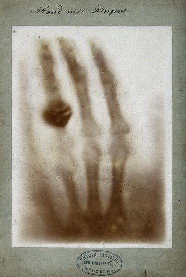 First medical X-ray