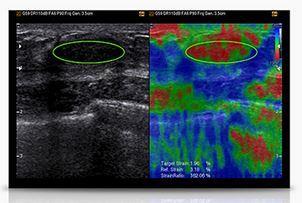 Elasto Scan for Breast Users obtain automatic