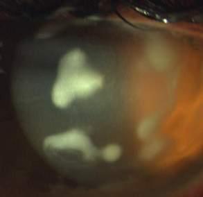 peripheral melting Corneal infiltrates after