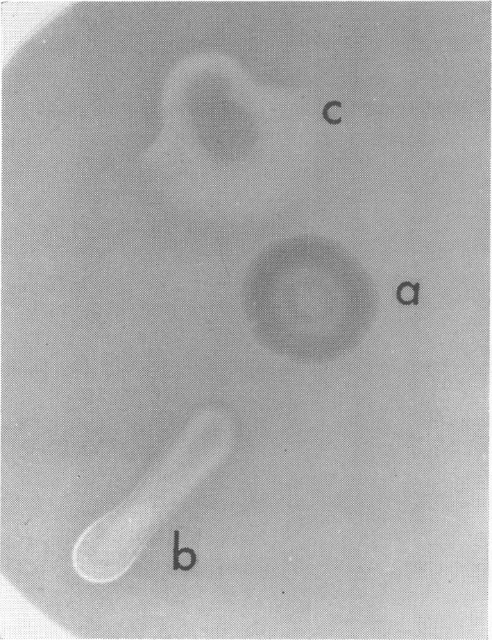 Inhibition of delta hemolysis by a Staphylococcus aureus strain not producing a dense red band. Colony a: S. aureus strain not producing a dense red band. Colony b: S.