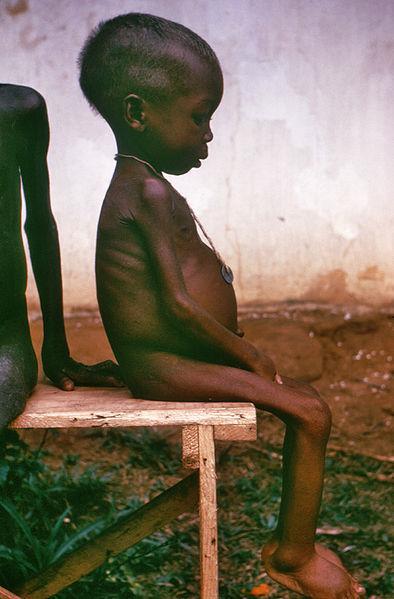 World Hunger Chronic malnourishment can lead to disease: Kwashiorkor is a disease