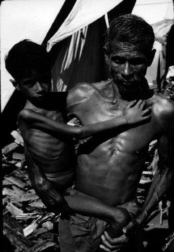 World Hunger Chronic malnourishment can lead to disease: Marasmus is a disease caused a protein and caloric deficiency