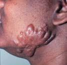 Keloid Scars The tough problem Progressive growth that extends past original scar Invades and destroys normal skin and tissue Cause of keloid formation still not understood; several theories