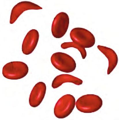 6 3. Sickle-cell anaemia is an inherited disease caused by a recessive allele (e). James and Chinaza are patients with a family history of sickle-cell anaemia.