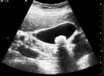 7 4. The ultrasound image below shows the liver of a patient suffering from gall stones. (a) Choose the correct terms from the box to complete the sentences below.