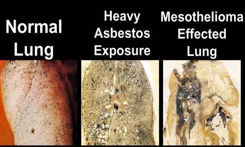 - Asbestosis - Lung Cancer - Mesothelioma *Disease