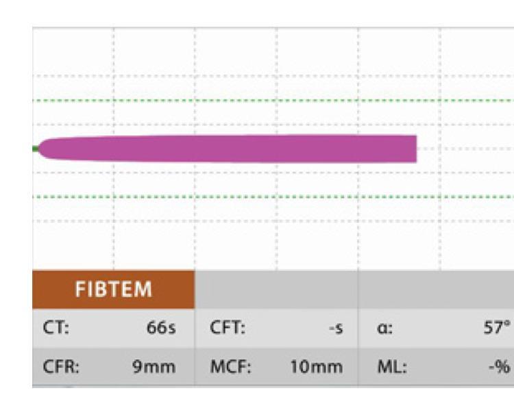 ROTEM assay : FIBTEM Fibrinogen level & Fibrin net polymerization