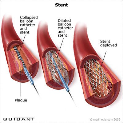 Use stent to improve restenosis Picture taken