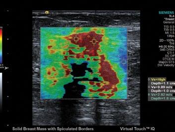 Advanced SieClear with Color maintain 2D imaging while scanning in color Doppler.