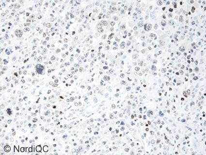 The staining reaction of the nuclei in the neoplastic cells is barely visible or abscent. Fig. 5a (x200) Insufficient BSAP staining of the colon.