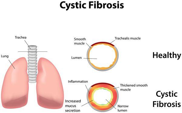 Genetic Mutations Example of harmful mutations: Cystic Fibrosis Some people inherit two copies of a mutated CFTR gene from their parents, which causes cystic