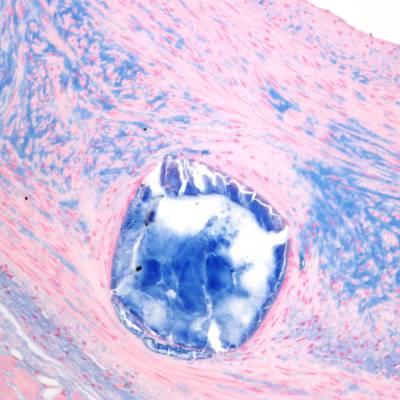 bioresorbed struts readily visible in histological sections