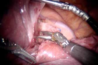 A 15-mm assistant port is employed to enable effective ligation of vascular and bronchial structures as well as specimen retrieval (extended to 2-3 cm) at the conclusion of the surgery.