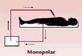 Monopolar Surgery Electric current from the active electrode through body to the return electrode, attached on the patient's skin.