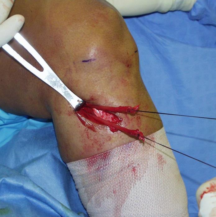 Summary Tissue engineering applications in ACL surgery A significant challenge Biocompatible