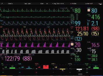 need it Product specifications MP80 MP90 Portal technology Compatible Compatible Waveforms 6, 8 (13 for ECG) 6, 8, or 12 per independent display (13 for ECG) Monitor screen display One independent