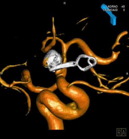 New disciplines Neurosurgery and orthopedics Indications and OR techniques Stereotactic procedures Aneurysm treatment