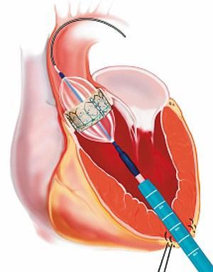 stenosis Open heart