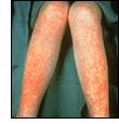 Severe reduction in the number of PLTs - thrombocytopenia this causes spontaneous bleeding as a reaction to minor trauma in the skin - reddish-purple blotchy rash it may result from: -