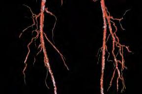 Atherectomy as Primary Therapy for Lower Extremity Artery Disease: What will Be its Role in the