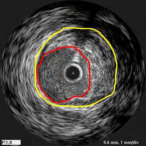 IVUS Post TURBO-Booster
