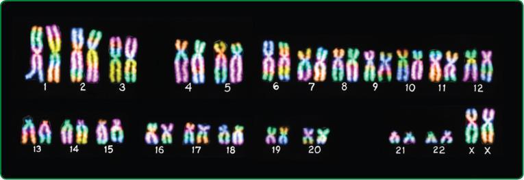 KARYOTYPES a person s particular set of chromosomes chromosomes are collected and stained when a cell is in metaphase so they appear as sister chromatid Xs. This is a human karyotype.