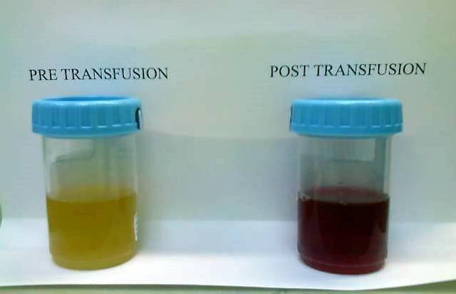 Post Transfusion Urine collected day 2 (July 2) at 11:23 -