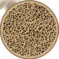 Marrow Cellution Percutaneous Bone Graft Collection Produces Autologous Cancellous Graft Material with Osteoconductive, Osteoinductive & Osteogenic Properties Minimally Invasive Cancellous Bone Core
