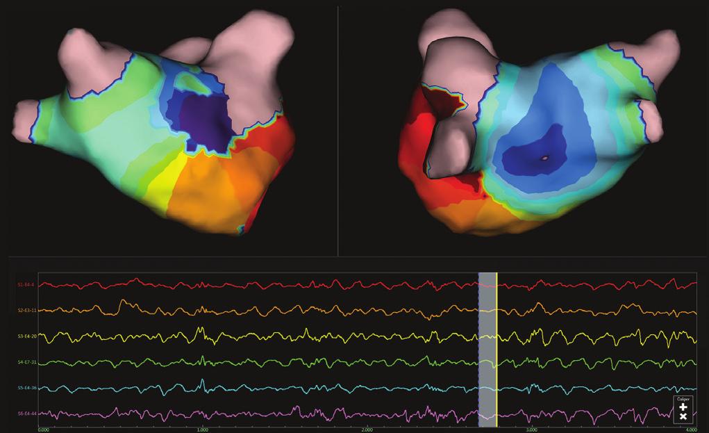 in visualizing the arrhythmic mechanisms to be targeted for ablation therapy. 1 Patrick Heck, MD, PhD, et al.