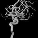 Clinical solutions that support efficient decision making and treatment of cerebral aneurysms Decide Obtain insight in the vasculature and visualize the location, size and neck of the aneurysm to