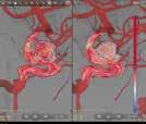 Support precise guidance of devices with MR-CT Roadmap Visualize lesion boundaries and corresponding vascularization to enhance accurate navigation through challenging pathologies, while managing