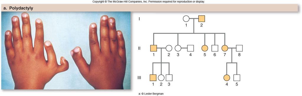 Polydactyly is seen here: It s an autosomal dominant so it typically appears in every generation.