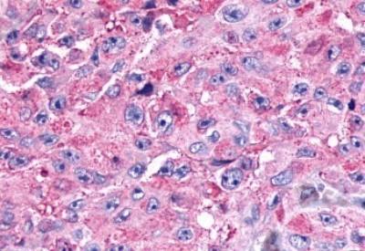 Images [NLS994] - Anti-SSTR1 antibody IHC of human Skin, Melanoma.