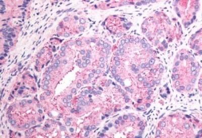 cell carcinoma.