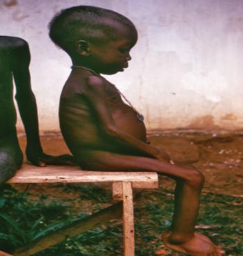 Marasmus Malnourishment Malnourishment- regardless of the number of calories a person consumes, their diets lack the correct balance of proteins, carbohydrates, vitamins and minerals Food Security-