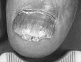The Lead Onychomycosis (fungal nail infection) provides an attractive topical first indication $5 bn,, poorly served global