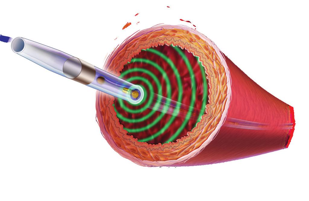Achieve More When treating thrombus EKOS ultrasonic devices are designed to gently accelerate the penetration of thrombolytic agents into thrombus, providing high levels of lysis performance and