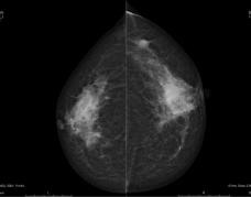 Breakthrough dose with high image quality CT Digital mammography Interventional X-ray idose4 iterative reconstruction Improved image