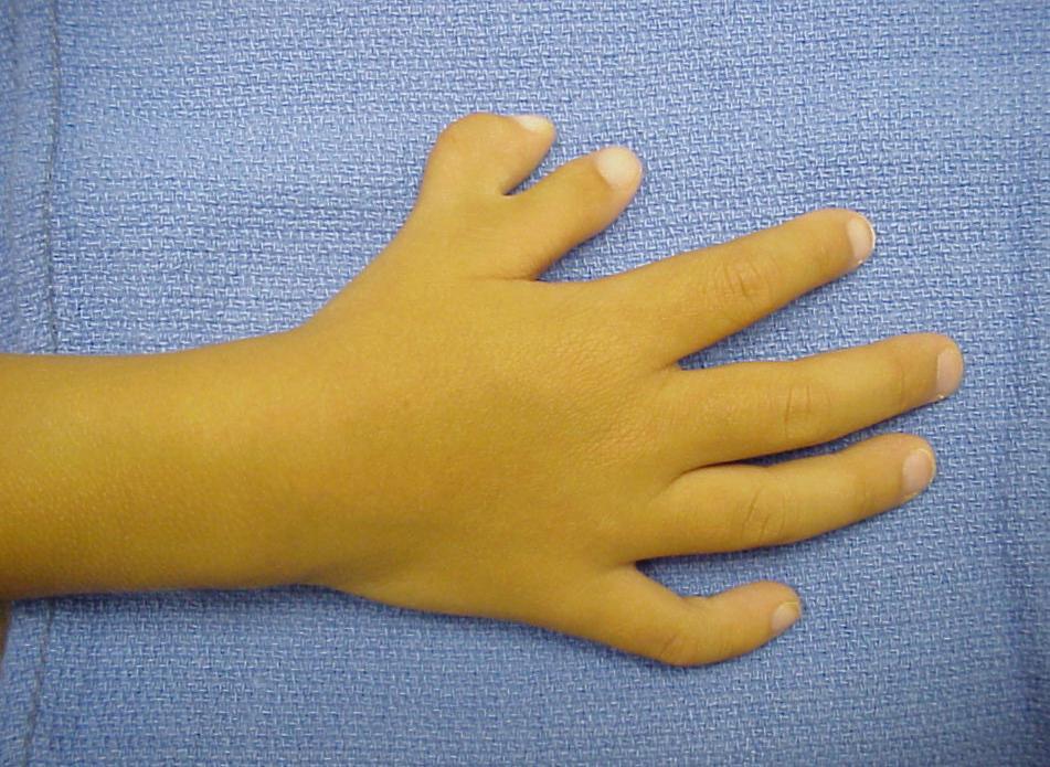 Polydactyly individuals are born with extra fingers or toes the allele for