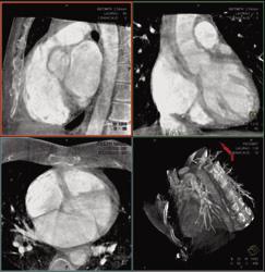 syngo DynaCT Cardiac also reduces costs by minimizing the need for pre-procedural CT or MR imaging. Intra-procedural 3D visualizations with syngo DynaCT Cardiac.