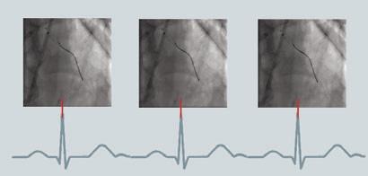 Control of device deployment without IC Stent. Left coronary artery without image processing. Same image as above with IC Stent. IC Stent. A deployed stent is sometimes hard to see which makes it difficult for the physician to judge proper outcome of the procedure.