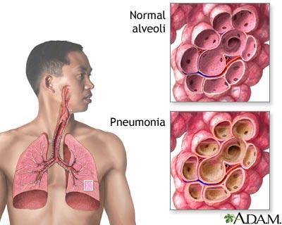 Streptococcus pneumoniae Lives in human upper respiratory system Multidrug